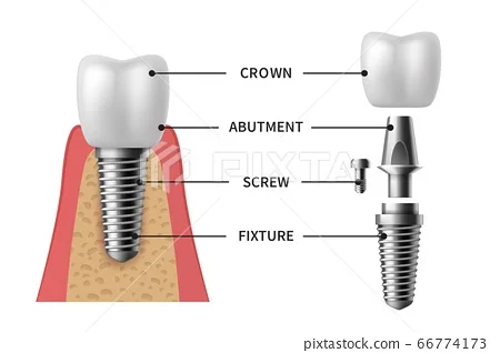 Dental implants1