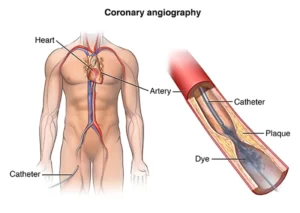 how to work Angiography