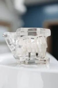 Dental implants