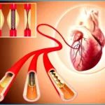 what is Stents and Angioplasty