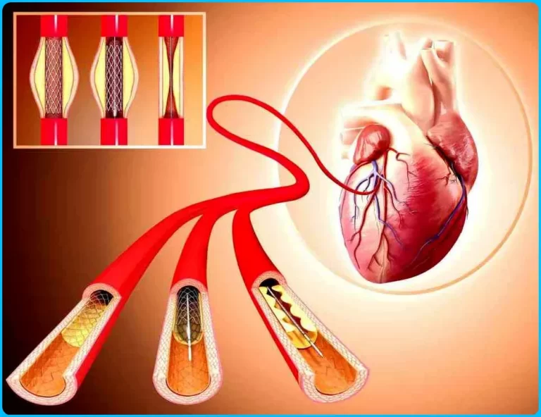 what is Stents and Angioplasty