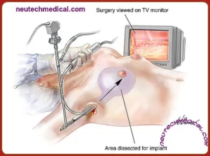 how to work breast implant