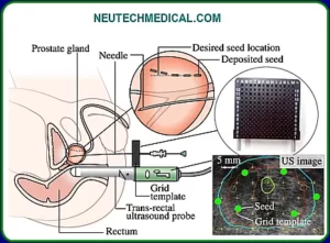 how to work brachytherapy