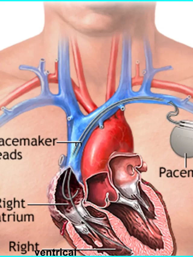 What is pacemaker, How to pacemakers work