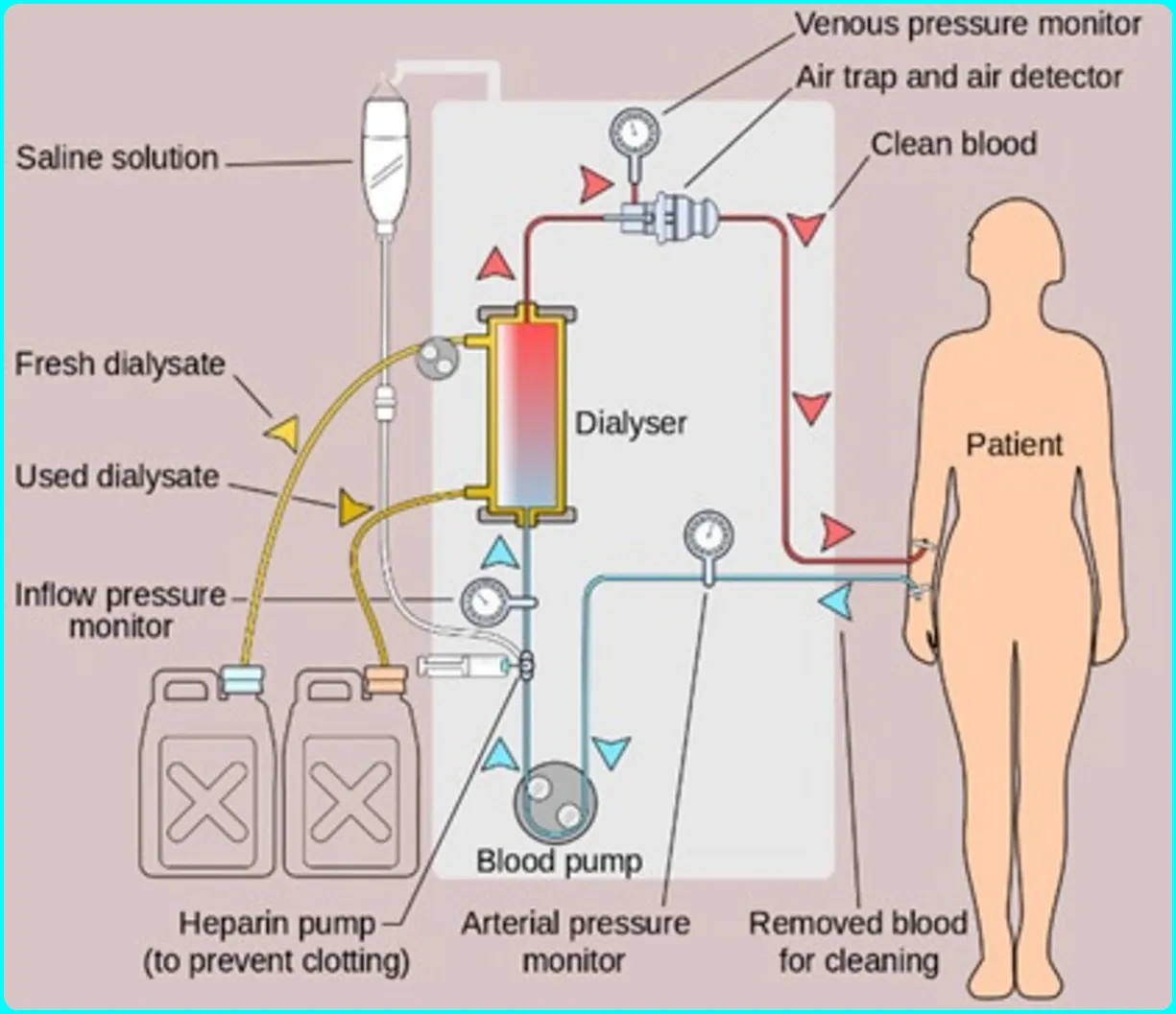 what are the hemodialysis