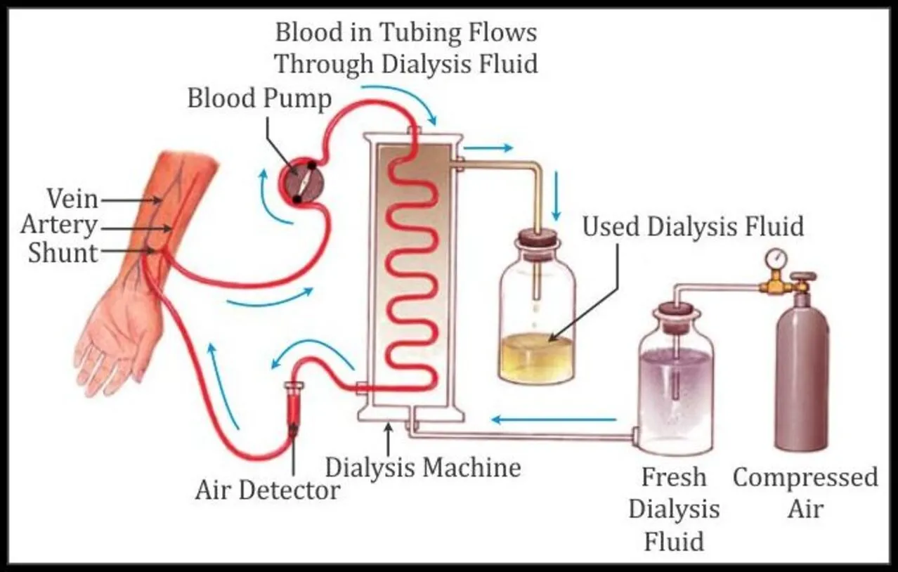what are the hemodialysis