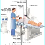 What is Lithotripsy, how to work lithotripsy