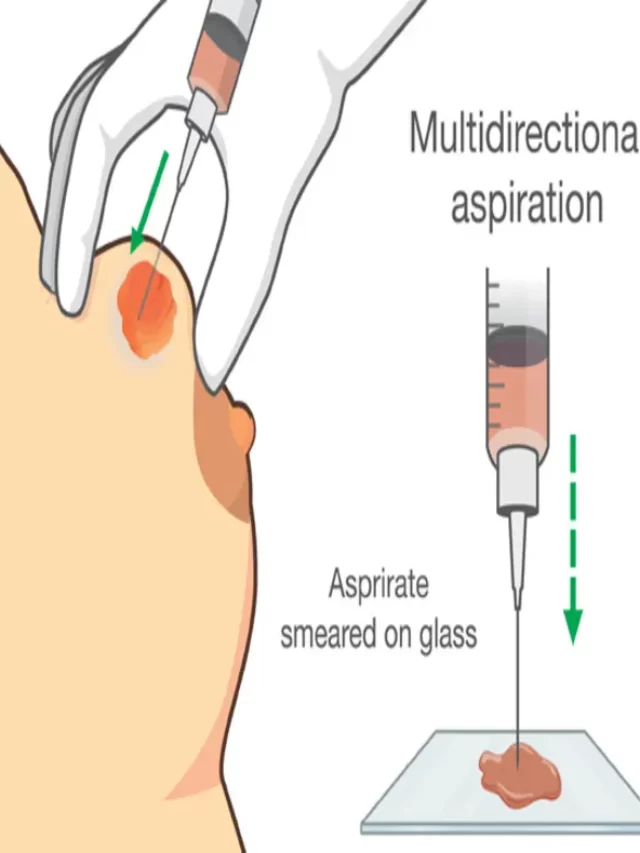 Early Stage Breast Cancer Ultrasound, Stage 2 Breast Cancer Ultrasound, Stage 3 Breast Cancer Ultrasound, Stage 4 Breast Cancer Ultrasound, Early Stage Breast Cancer Ultrasound Images.