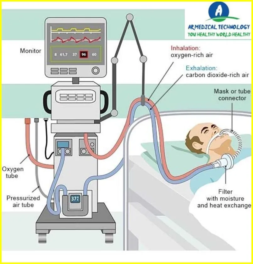 At What Oxygen Level is a Ventilator Needed