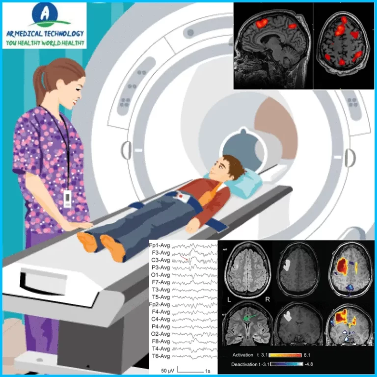 Normal Brain MRI but Abnormal EEG