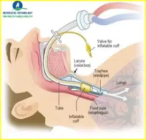 Ventilator Definition