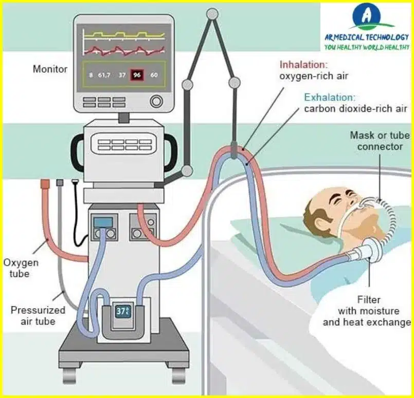 What Does a Ventilator Do