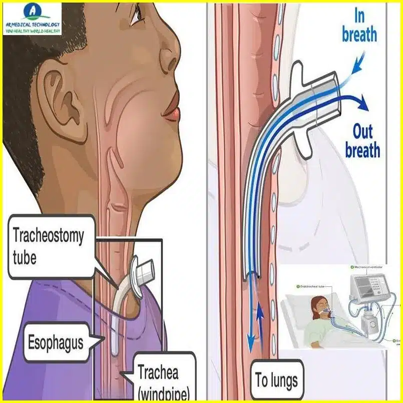 tracheostomy vs ventilator covid