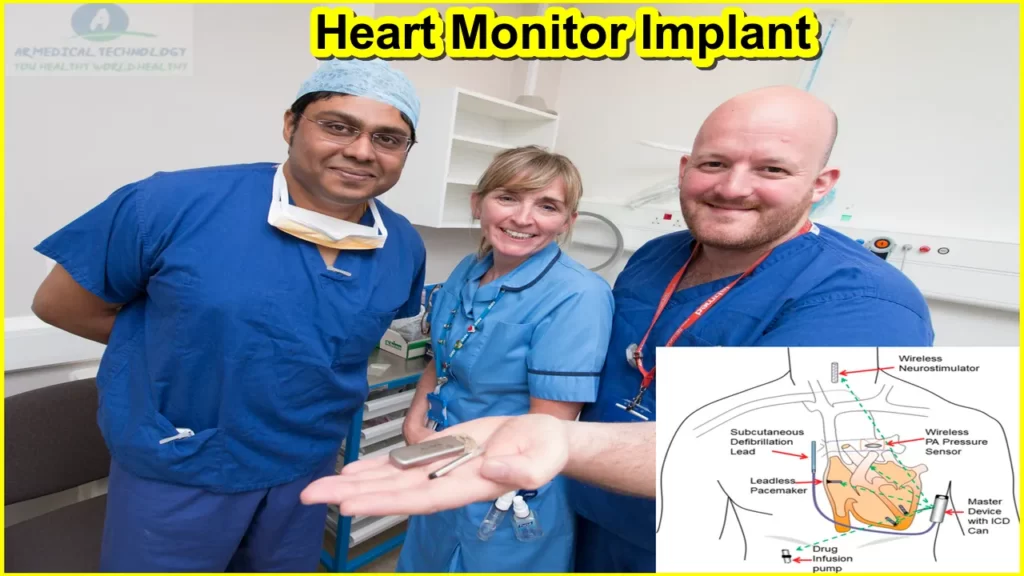 what-is-a-heart-monitor-implant-best-inside-the-beat-how-to-heart