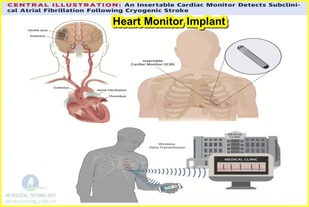 What is a Heart Monitor Implant best Inside the Beat How to Heart