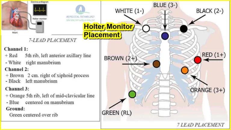 Holter Monitor Placement