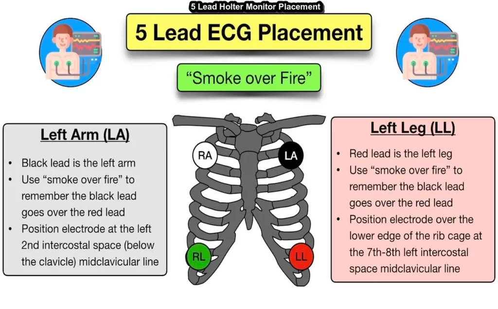 5 Lead Holter Monitor Placement