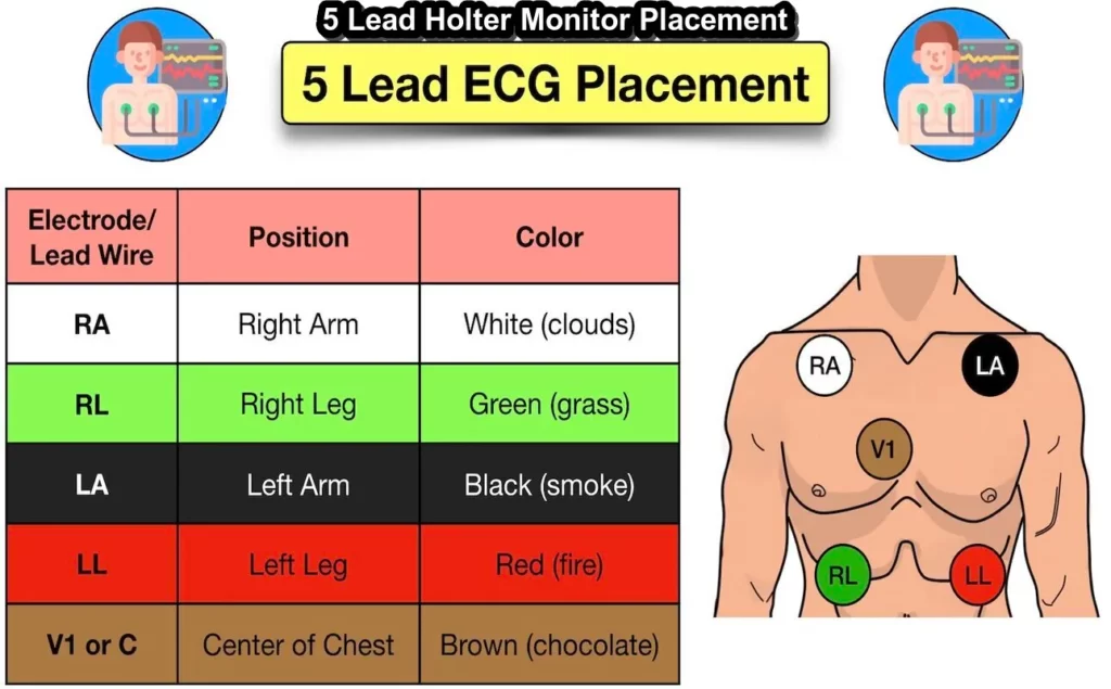 5 Lead Holter Monitor Placement: Best Lead ECG Cable/Electrode Three(3 ...