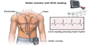 holter monitor test