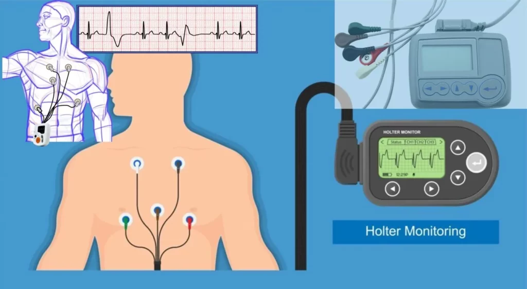 What is the Holter Monitor Working Principle, Best Uses and Types 24