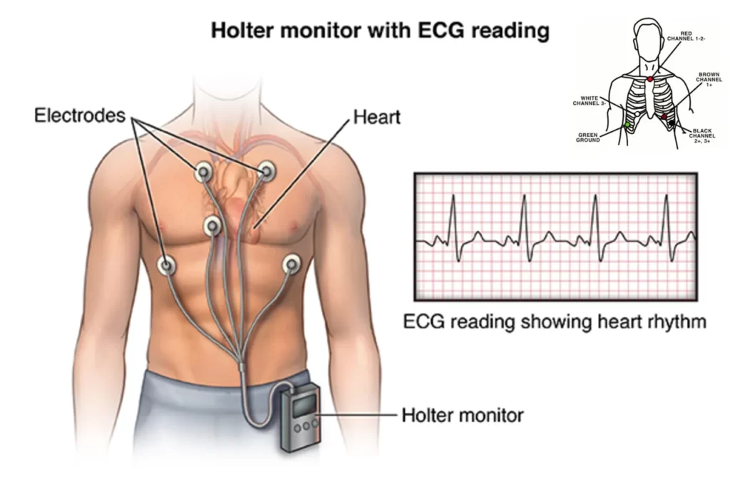 Holter Monitor Instructions