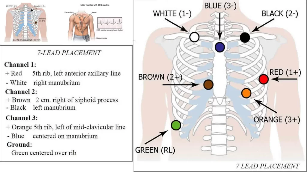 What Does a Holter Monitor Do