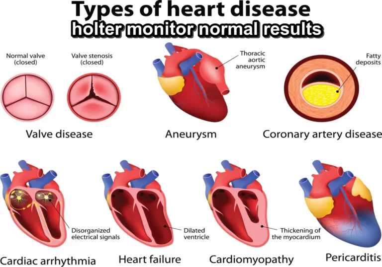 holter monitor normal results