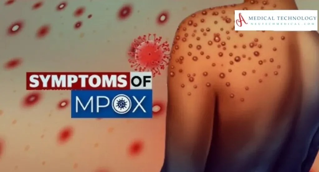 Mpox Virus Outbreak