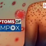 Mpox Virus Outbreak