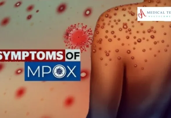 Mpox Virus Outbreak