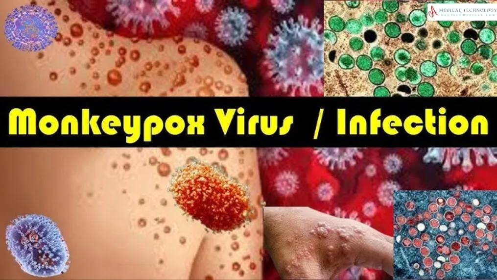 Mpox Virus Outbreak